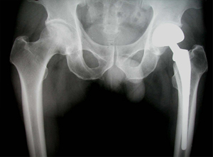 고관절 치환술 후 X-선